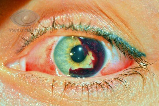 Контузия глаза: причины, степени, симптомы и лечение