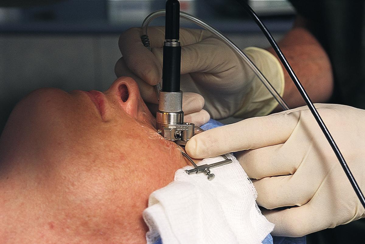 Операция глаукомы, виды операций, подготовка и послеоперационный период.