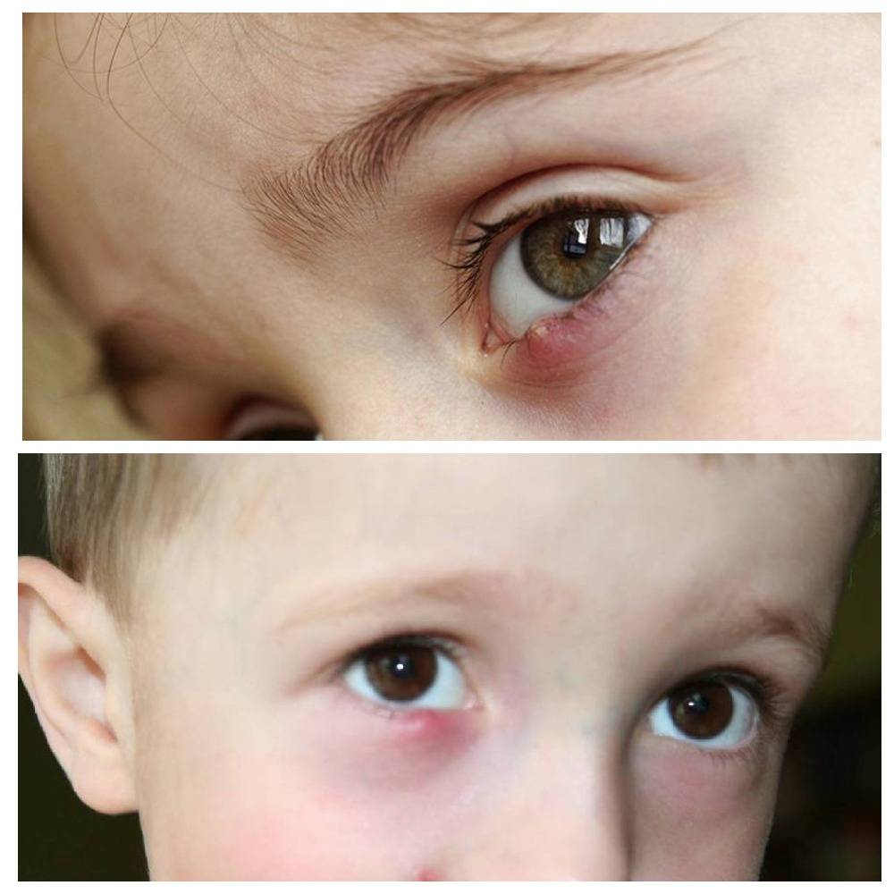 Е. комаровский: как лечить ячмень на глазу у ребенка: чем лечить, что делать