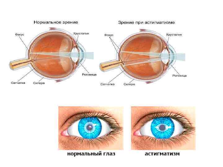 Близорукость | мнтк «микрохирургия глаза» им. акад. с.н. федорова