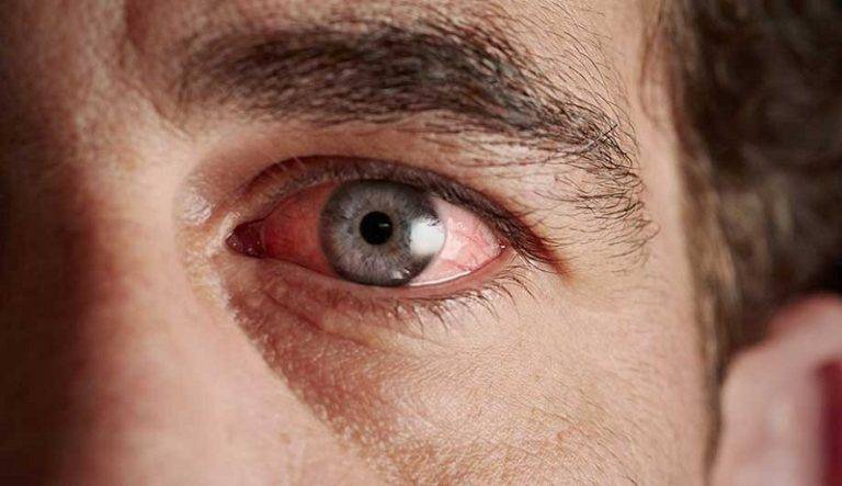 Болят глаза от компьютера, синдром компьютерного зрения. боль в глазах от компьютера симптомы и лечение.