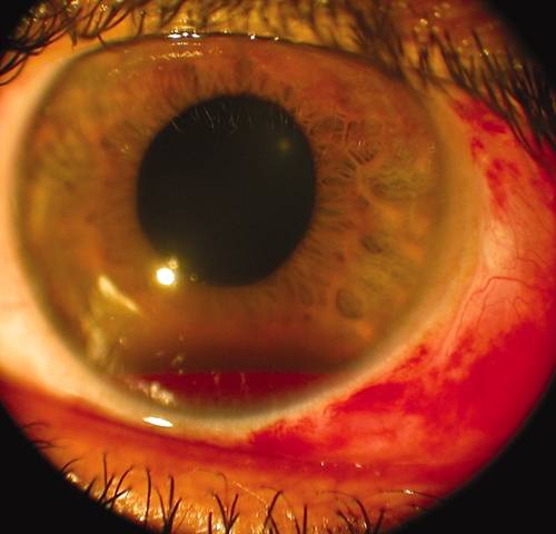 Гемофтальм или кровоизлияние в глаз, лечение, причины. профилактика гемофтальма.