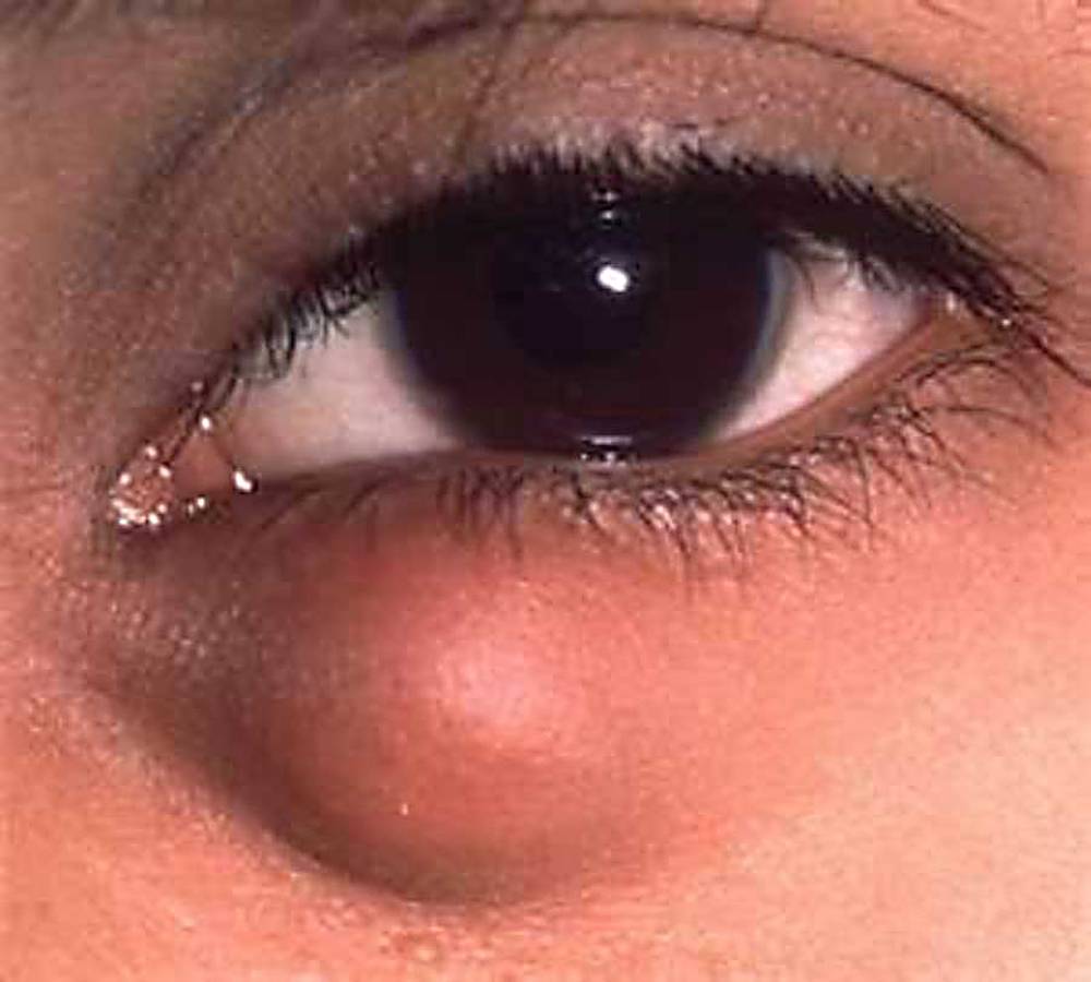 Киста на глазу: симптомы, причины и методы лечения