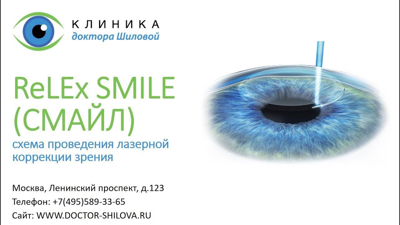 Relex smile (смайл) лазерная коррекция зрения - как проводят, последствия, отзывы
