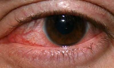 Простуда на глазу - как лечить, симптомы, фото