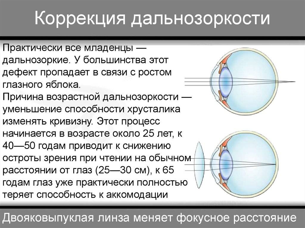 Линзы для зрения дальнозоркость. Патология рефракции гиперметропия. Аномалии рефракции глаза близорукость дальнозоркость таблица. Гиперметропия клинические рекомендации 2022. Коррекция пресбиопии при близорукости.