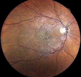 Что такое эпиретинальный фиброз глаза