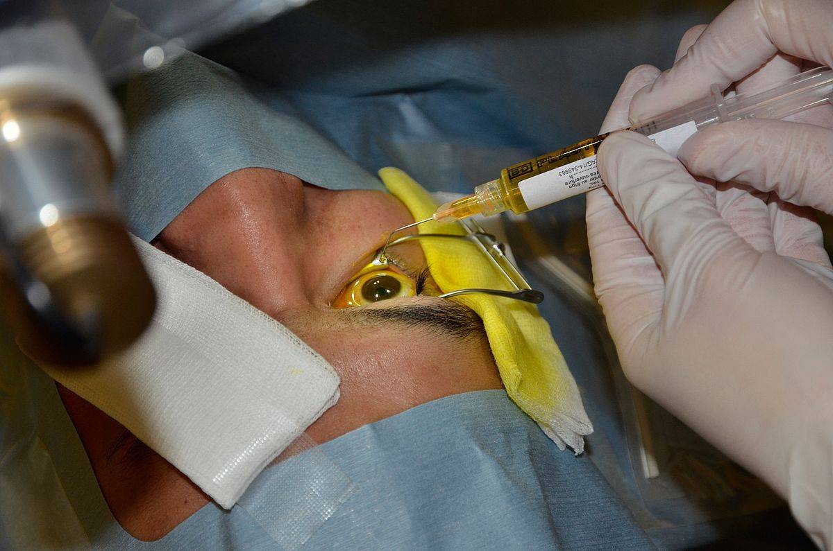 Кросслинкинг. лечение болезней роговицы глаза