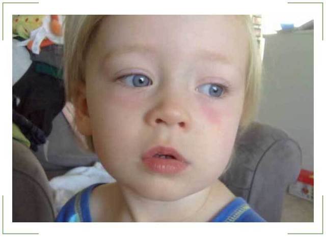 У ребенка красные глаза - причины, что делать и как лечить патологию