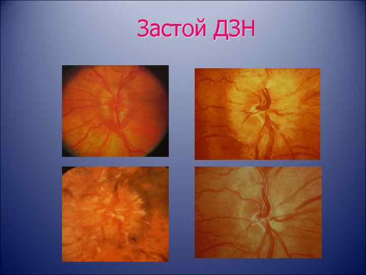 Застойный диск зрительного нерва: симптомы, лечение, причины