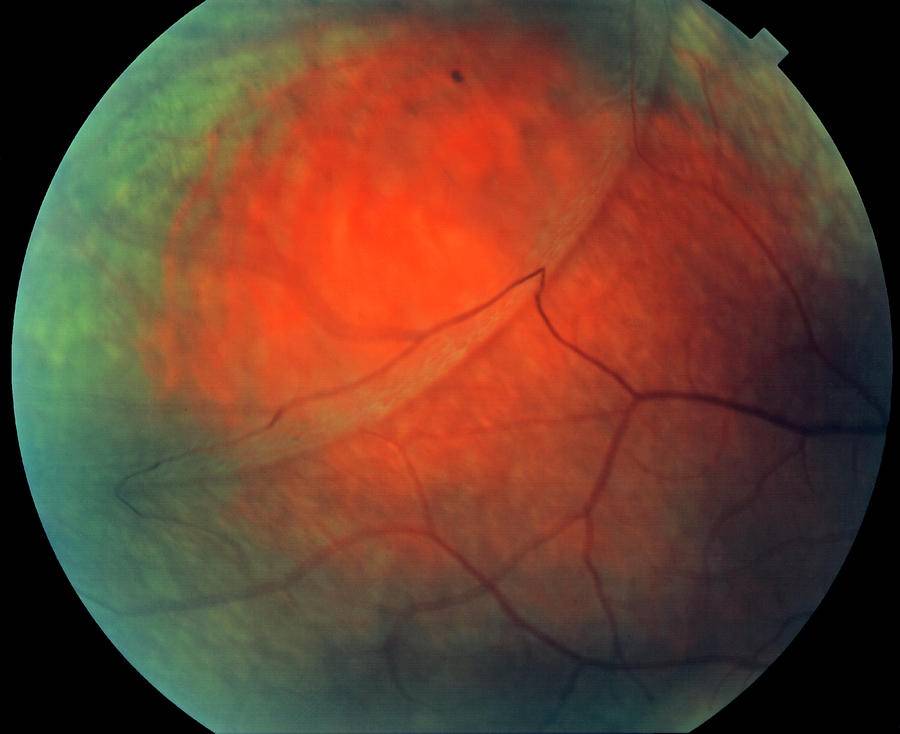 Ретиношизис глаза — что это за патология и как от нее избавиться?