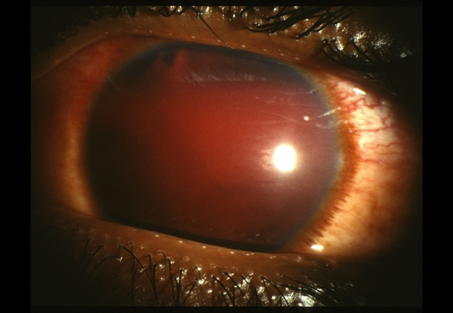 Лечение гифемы глаз, причины, симптомы, фото