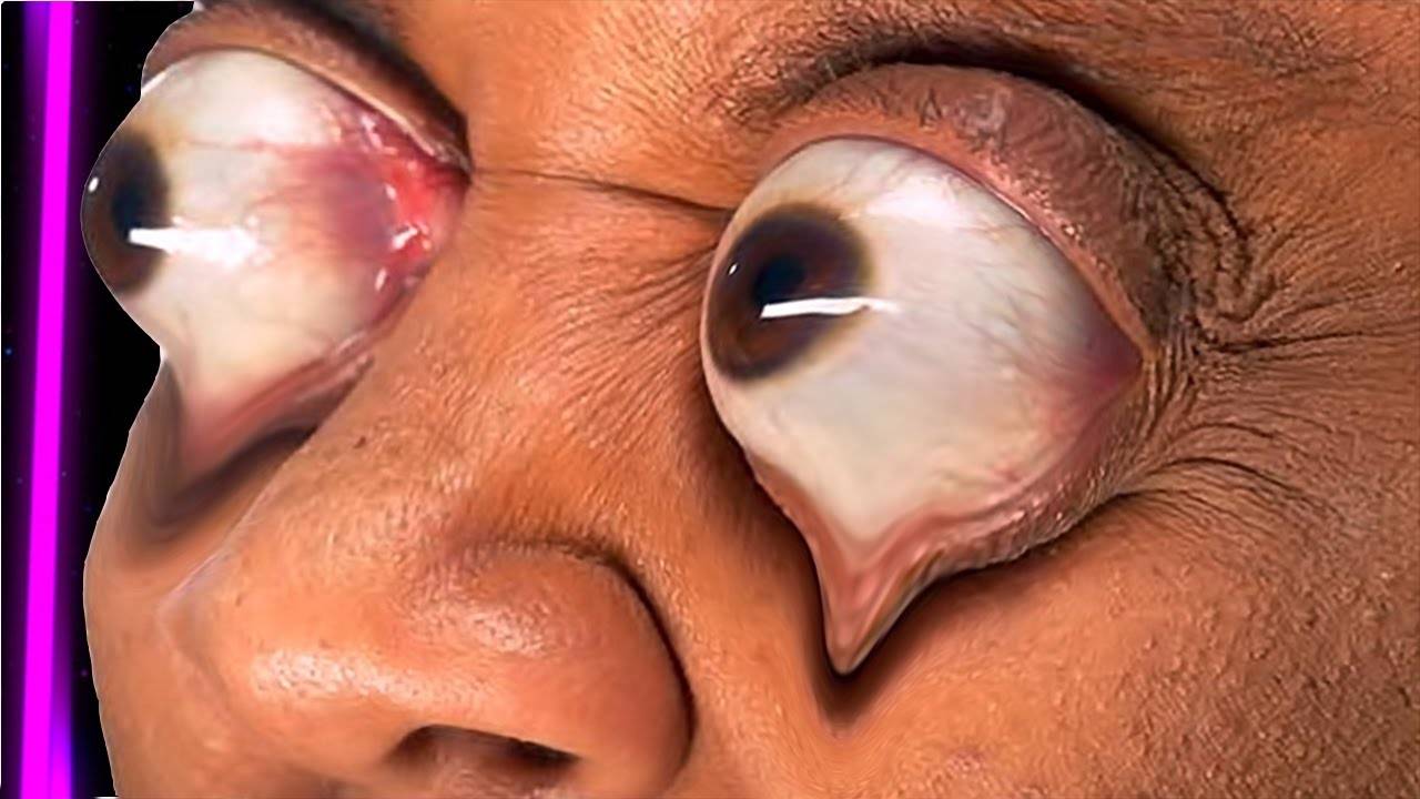 Нарост на глазном яблоке у человека - прозрачный или желтый, причины, как избавиться