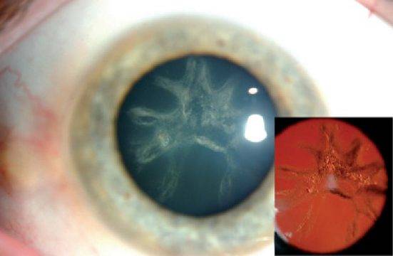 Операция по замене хрусталика глаза: при катаракте, близорукости и т.д., цена, осложнения, отзывы