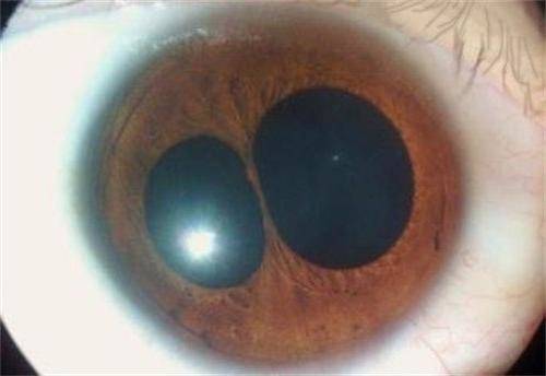 Поликория глаз: как видит человек, симптомы (фото), причины, лечение нескольких зрачков, диагностика, профилактика
