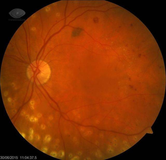 Отек сетчатки глаза: причины, лечение, симптомы макулярной отечности, виды (кистозный, диабетический, дистрофический), народные средства