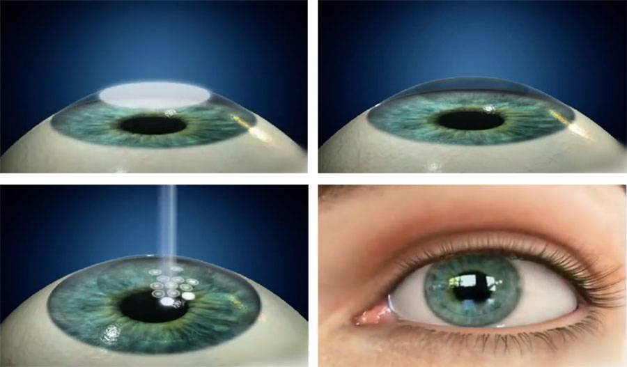 Операции на глаза при близорукости: какой способ выбрать
