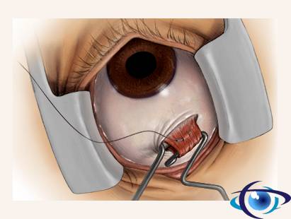 Склеропластика: как проходит операция - "здоровое око"