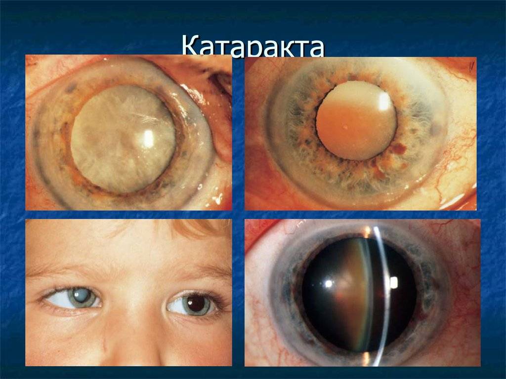 Операция по удалению катаракты: показания, ход, восстановление