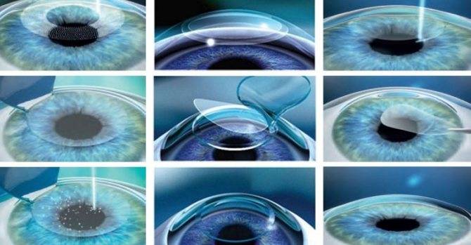 Астигматизм — последствия после лазерной коррекции, противопоказания к операции — глаза эксперт