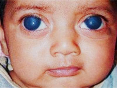 Глаукома у детей