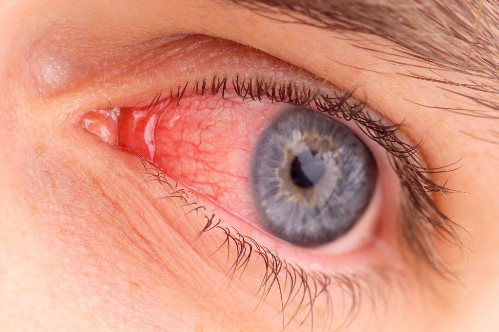 Кровоизлияние в глаз: причины, лечение, последствия и что делать