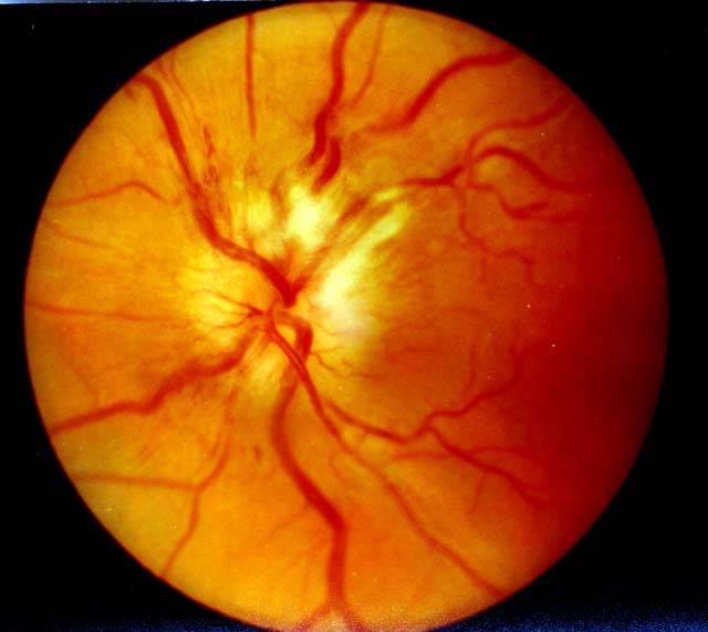 Ретробульбарный неврит (воспаление) зрительного нерва: симптомы и лечение