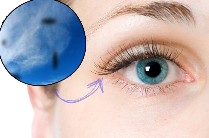 Черные точки в глазах - что это такое: почему появляются, симптоматика заболевания, как избавиться от пятен