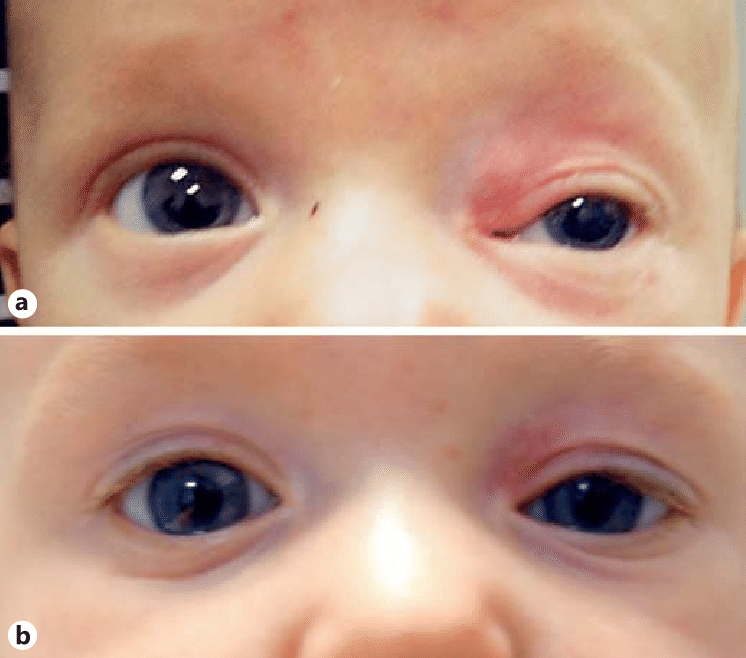 Гемангиома глаза у новорожденных детей: лечение и диагностика