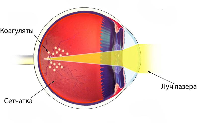 Ограничения после лазерной коагуляции сетчатки глаза, осложнения