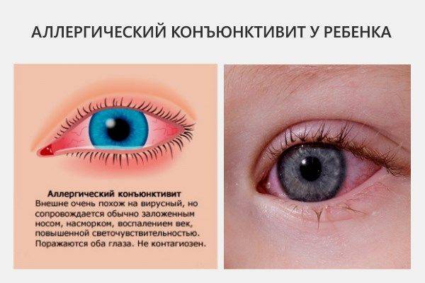 Ай-яй, красный глаз! острый конъюнктивит у детей, его симптомы, лечение