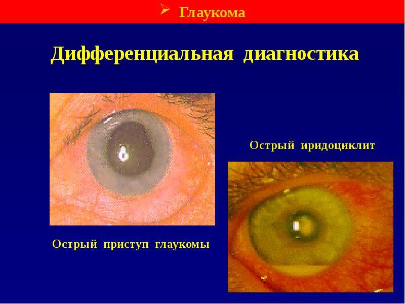 Острый приступ глаукомы: симптомы и лечение