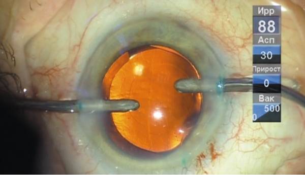 Факоэмульсификация катаракты с имплантацией интраокулярной линзы иол