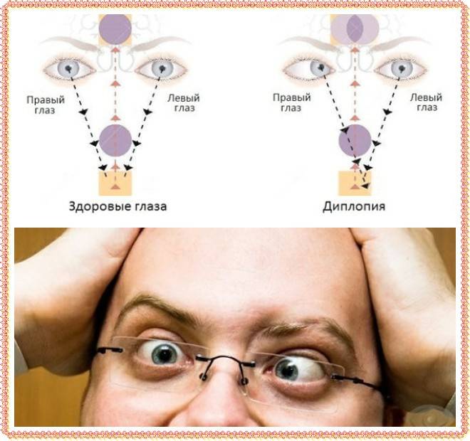 Диплопия (двоение в глазах): симптомы и причины - "здоровое око"
