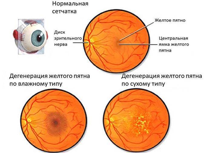 Резко перестал видеть глаз пелена какая то. сочетание помутнения зрения и головокружения. когда пелена сопровождается сопутствующими симптомами.