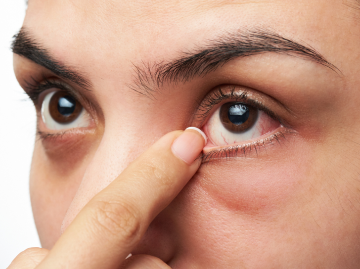 Шелушатся веки глаз: причины и симптомы - "здоровое око"