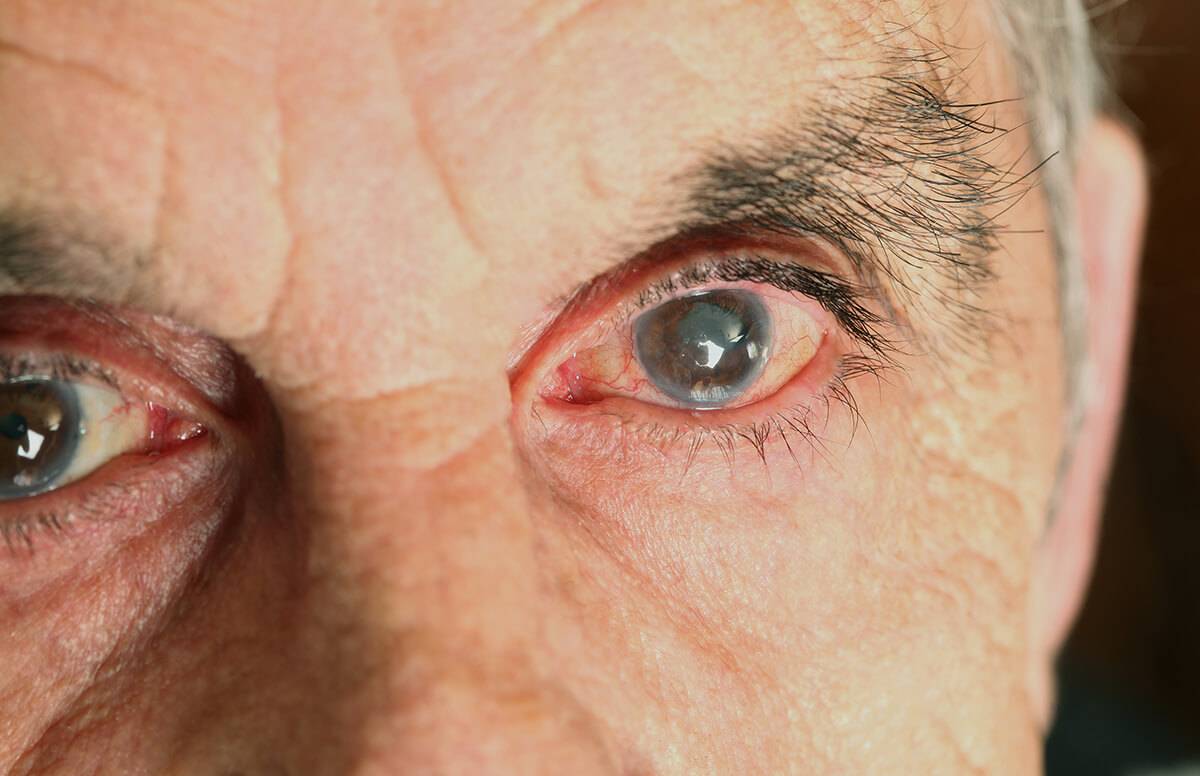Как лечить скотому глаза и возможно ли сохранить зрение?