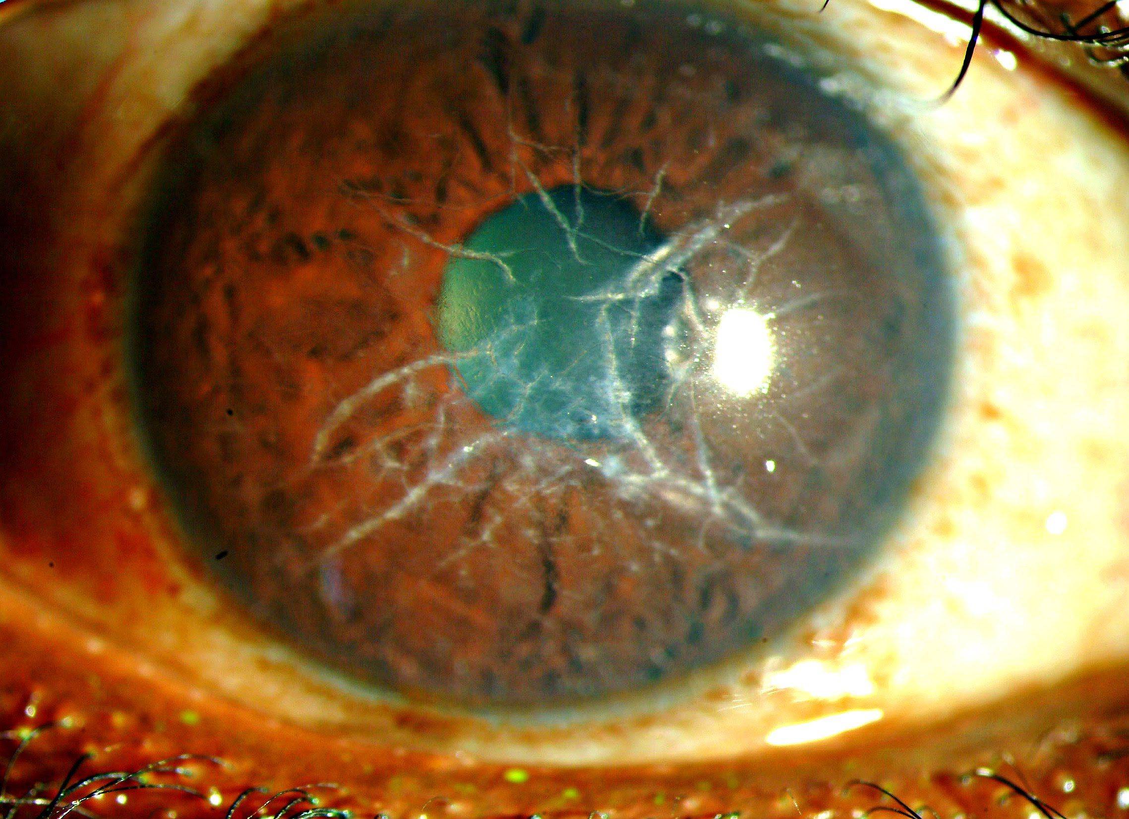 Дистрофия роговицы глаза - лечебные линзы при дистрофии роговицы, капли и народные средства | медицинский портал spacehealth
