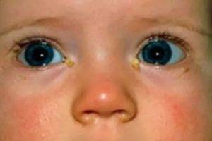 У ребенка красные глаза и гноятся – чем лечить, что делать