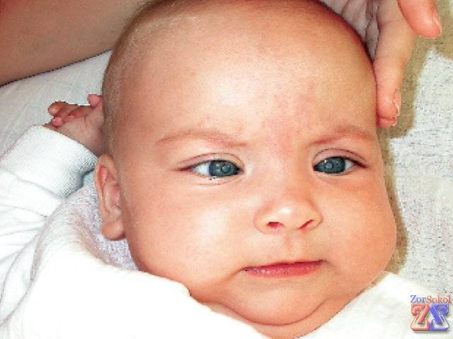 Мкб 10 - врожденная катаракта глаз у новорожденных детей: причины и лечение