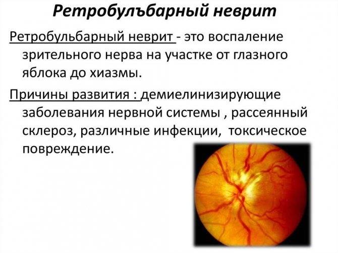 Ретробульбарный неврит и зрительного глазного нерва: код по мкб-10, симптомы патологии оптических нервов, причины, лечение и прогноз