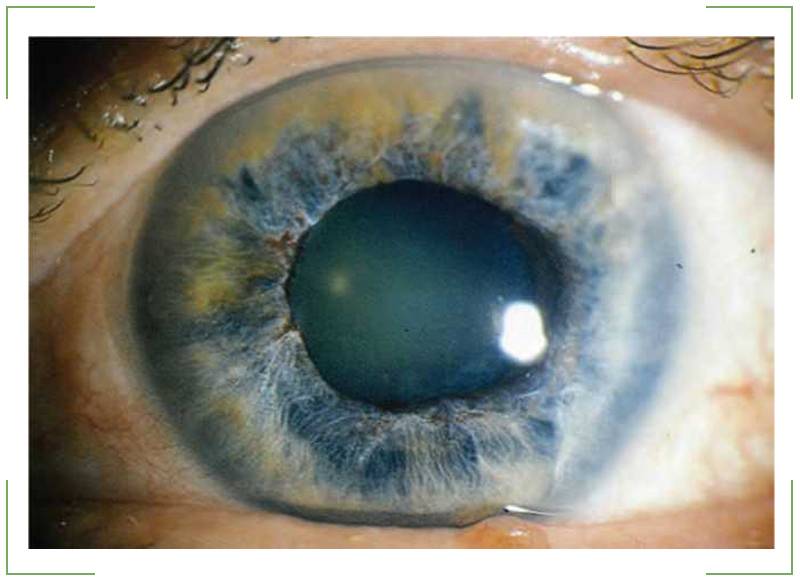 Закрытоугольная глаукома - что это, причины, симптомы и лечение