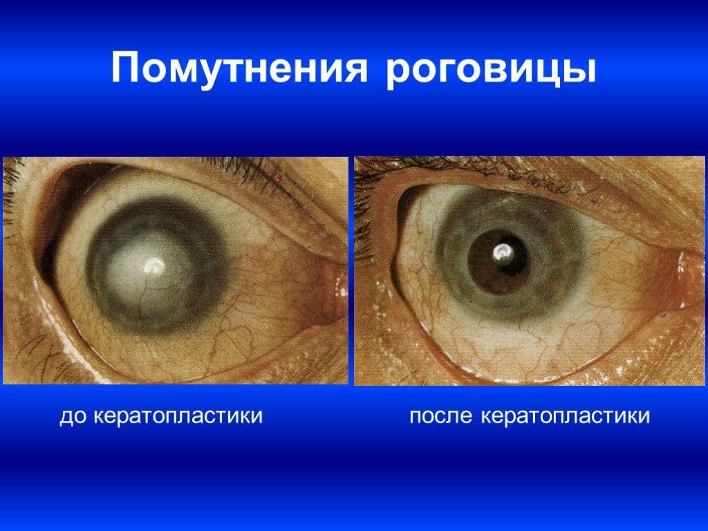 Помутнение роговицы глаза (лейкома, бельмо): разбираемя в причинах и методах терапии