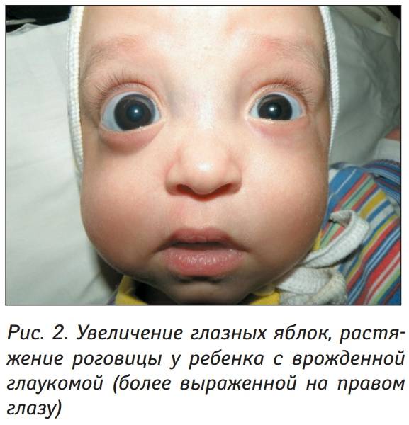 Врожденная глаукома: причины и последствия патологии у детей, методы лечения