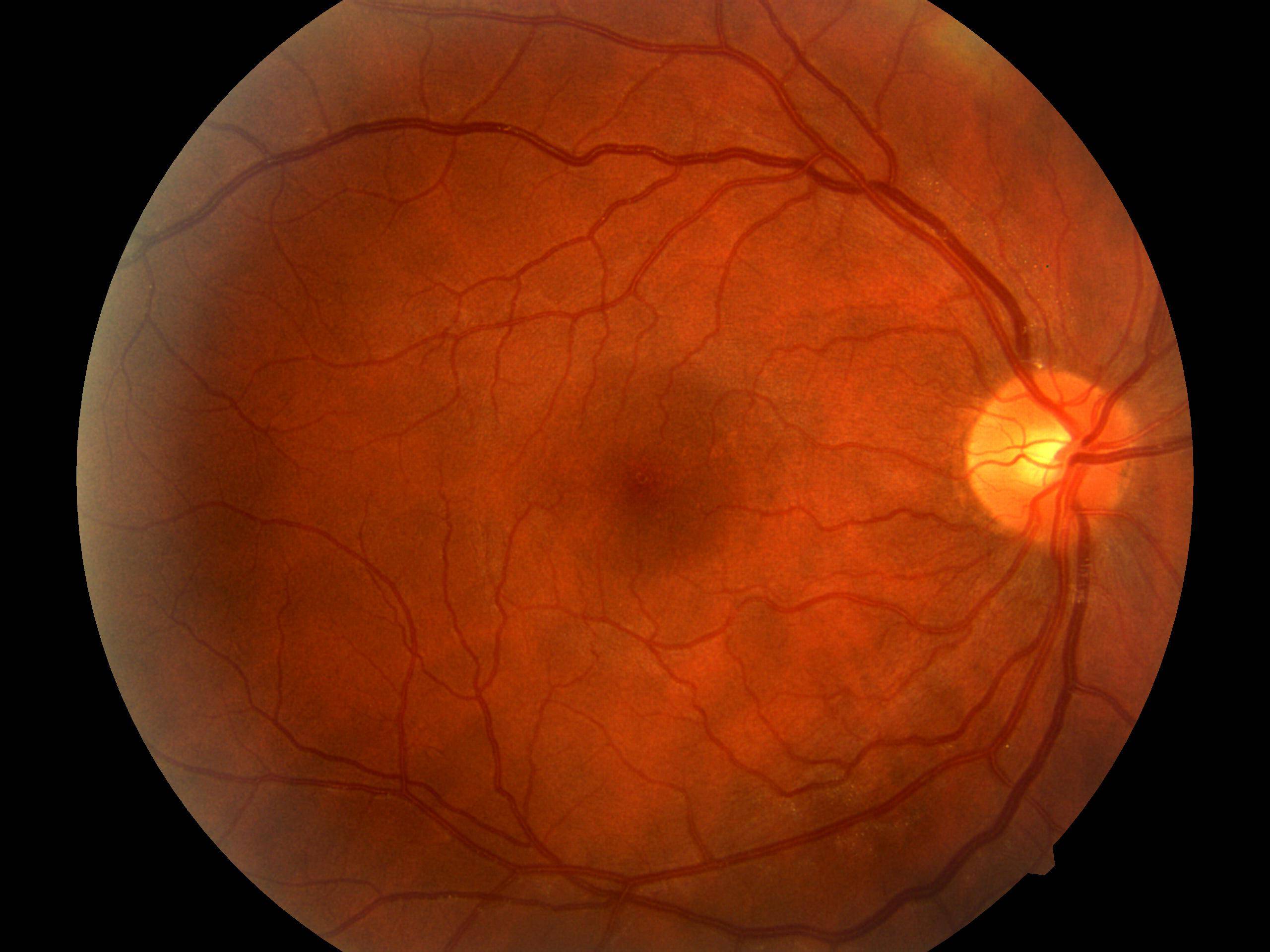Ангиопатия сетчатки глаза: причины, виды, лечение