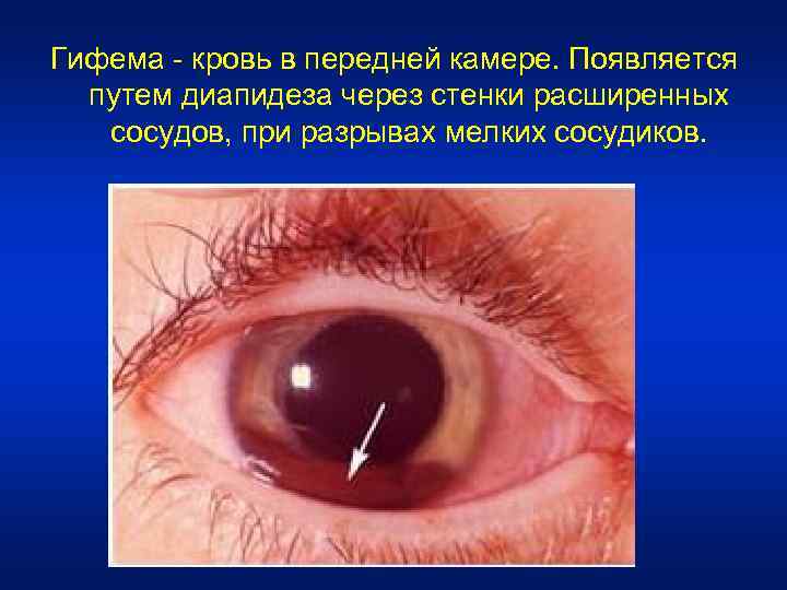 Гифема, причины, симптомы, лечение. глазные болезни на портале vseozrenii.