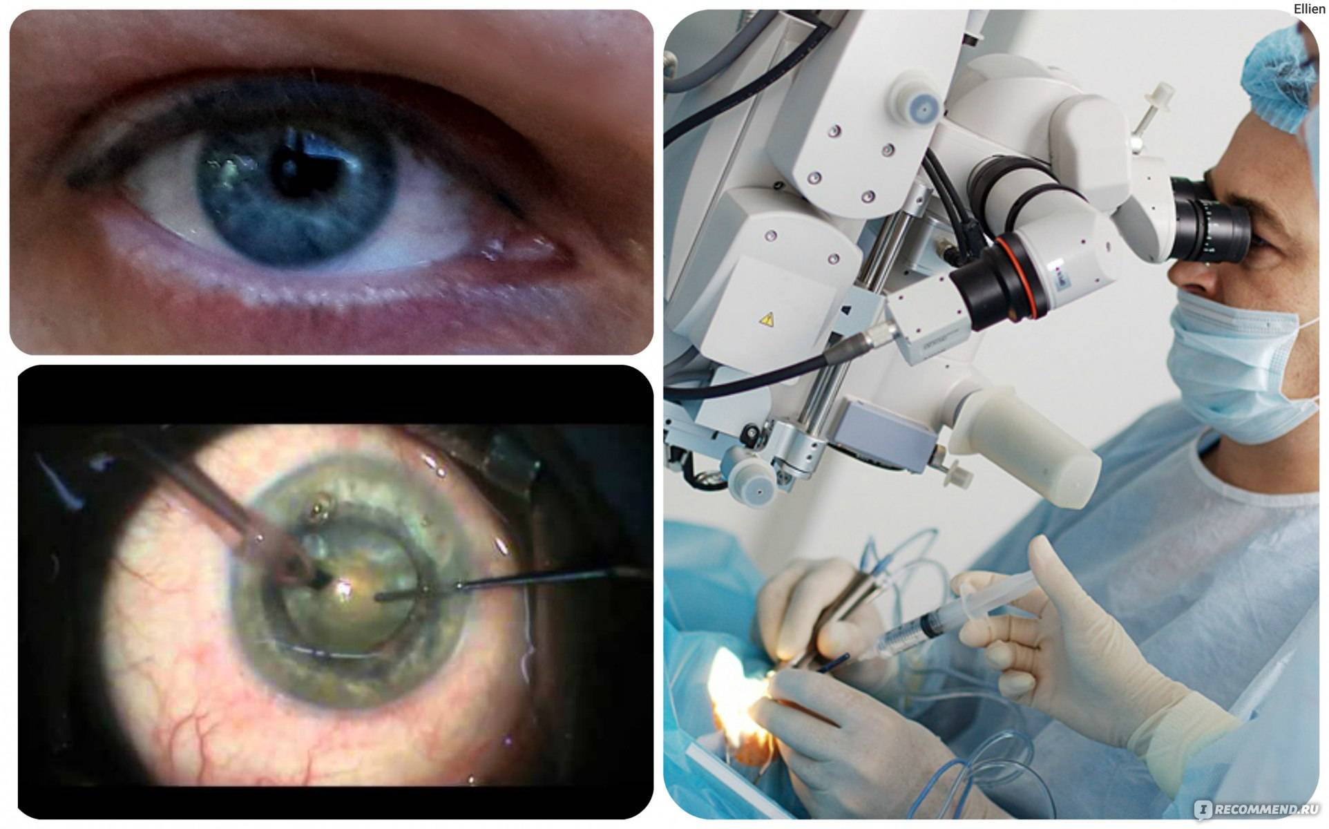 Незрелая катаракта: что это такое, как распознать, нужна ли операция