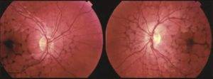 Пвхрд глаза: что это такое, расшифровка термина, причины и симптомы периферической витреохориоретинальной дистрофии сетчатки правого или левого глаза