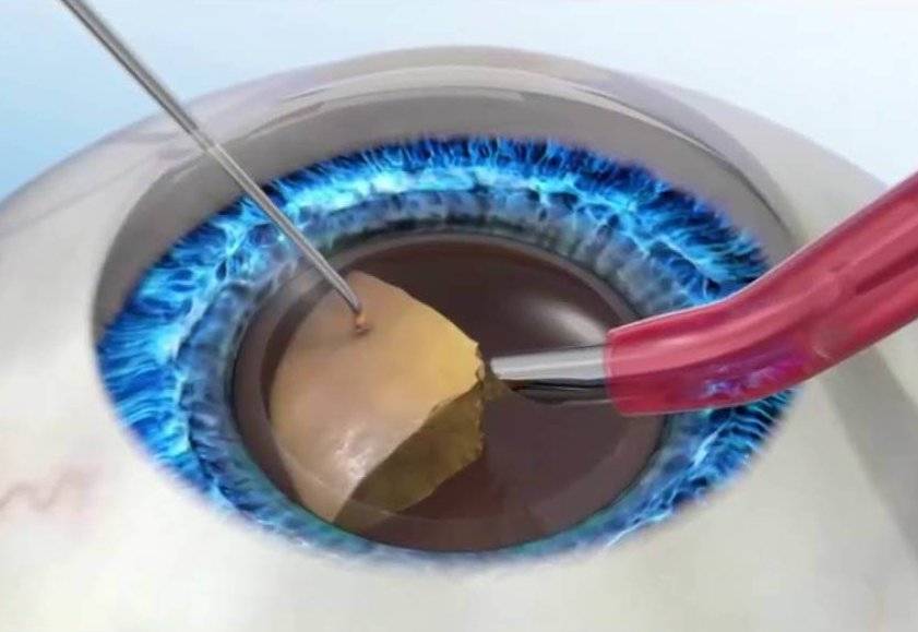 Лечение и удаление катаракты глаз лазером – особенности и рекомендации