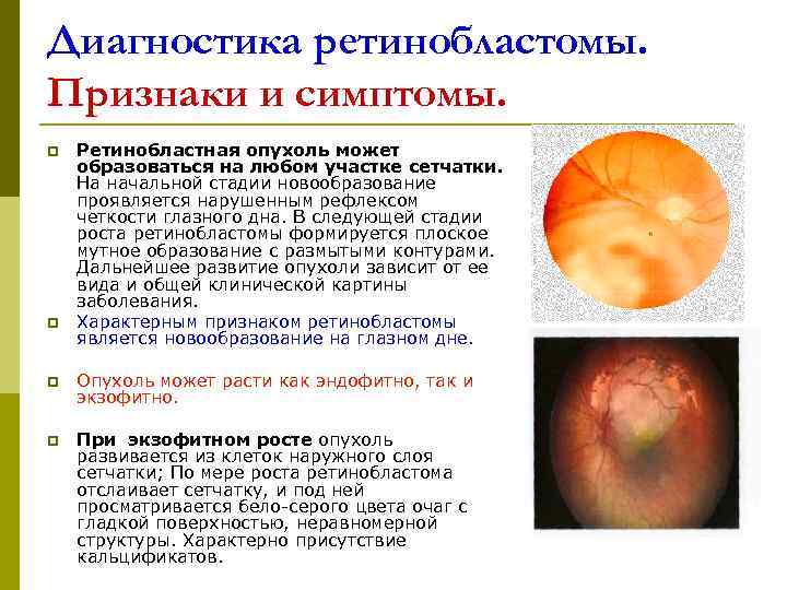 Ретинобластома: злокачественная опухоль сетчатки у детей